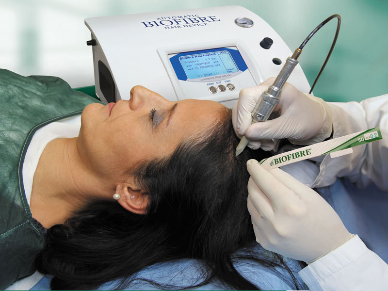 Implantation de cheveux Biofibre