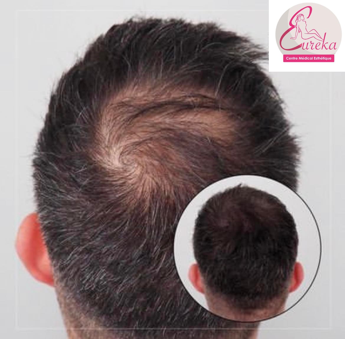 Dermopigmentation cuir chevelu